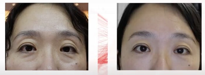 smooth-eye-before-after-01b