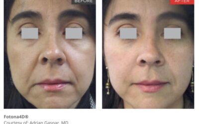 Achieve a 4D Non-Surgical Facelift