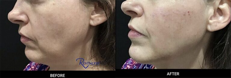 cheek-filler