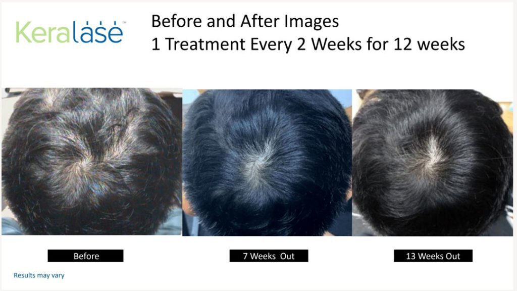 keralase-official-before-after-02-1024x576