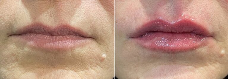 lip-filler-before-after-01