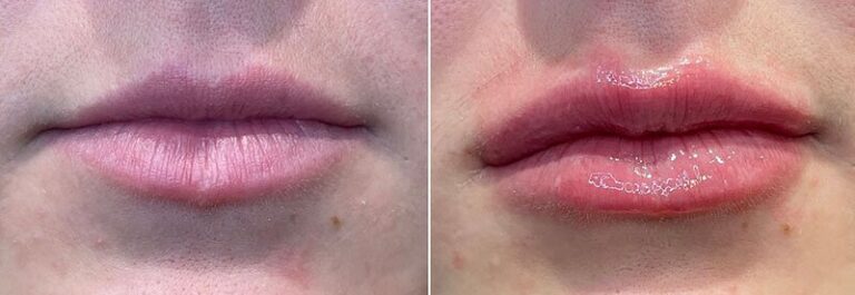 lip-filler-before-after-02