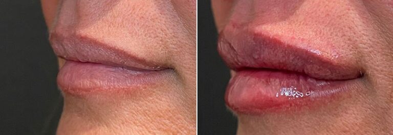 lip-filler-before-after-03