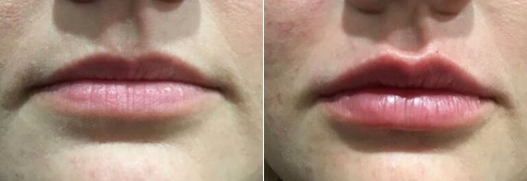lip-filler-before-after-05