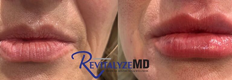 lip-filler-before-after-08