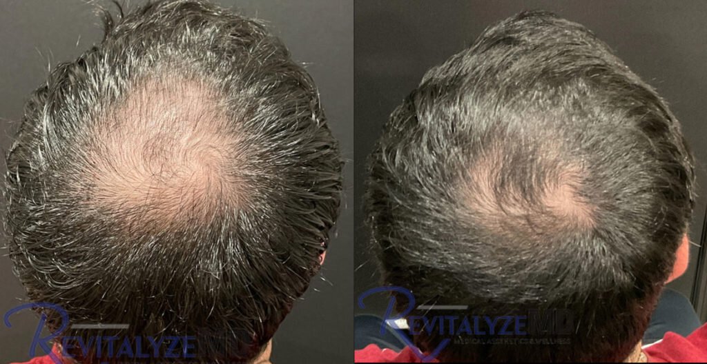 revitalyzemd-hair-restoration-before-after-01-1024x528