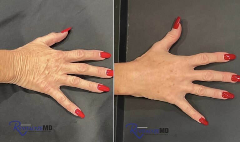 revitalyzemd-hand-filler-before-after-01