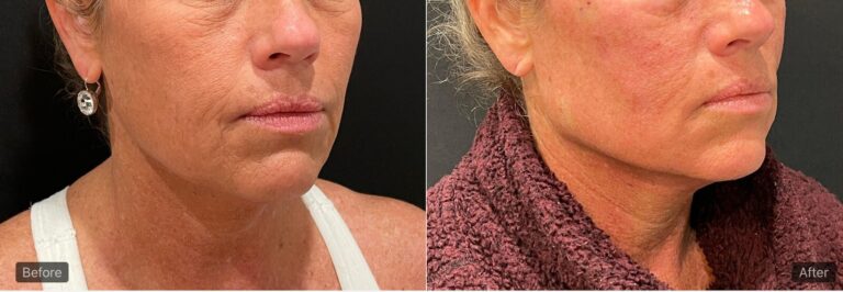 revitalyzemd-jawline-fillers-before-after-01