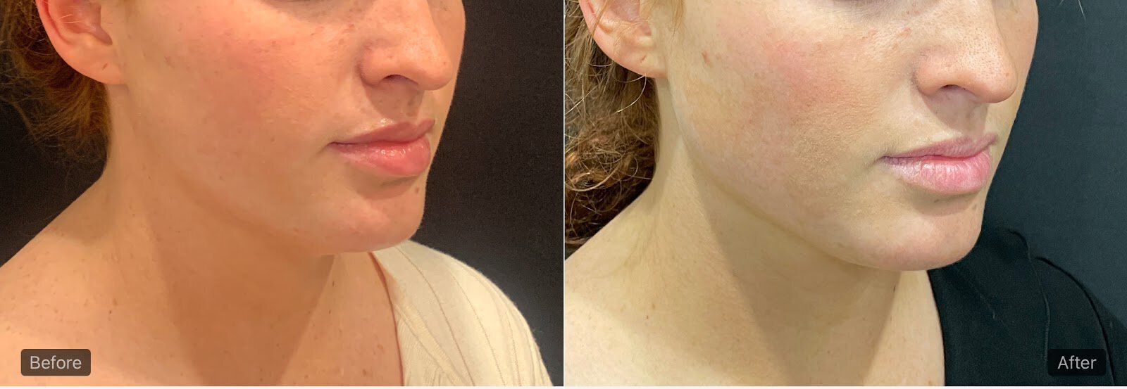 revitalyzemd-jawline-fillers-before-after-02