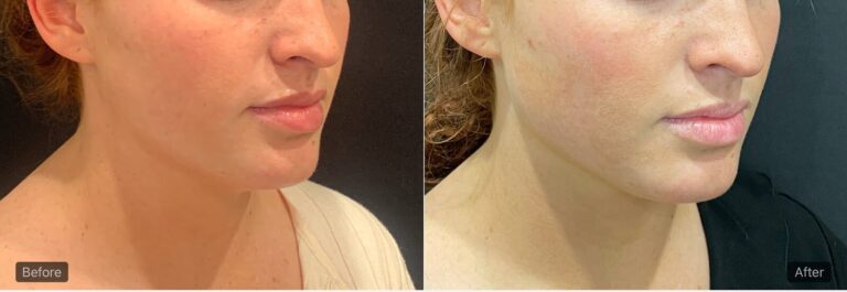revitalyzemd-jawline-fillers-before-after-02