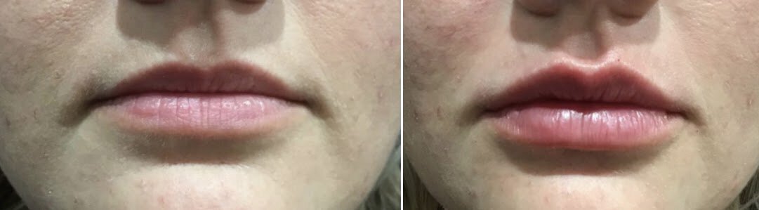 revitalyzemd-lip-filler-before-after-03