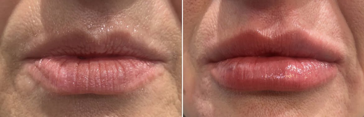 revitalyzemd-lip-filler-before-after-05