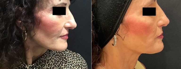 revitalyzemd-nose-filler-before-after-01