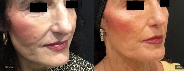 revitalyzemd-nose-filler-before-after-02