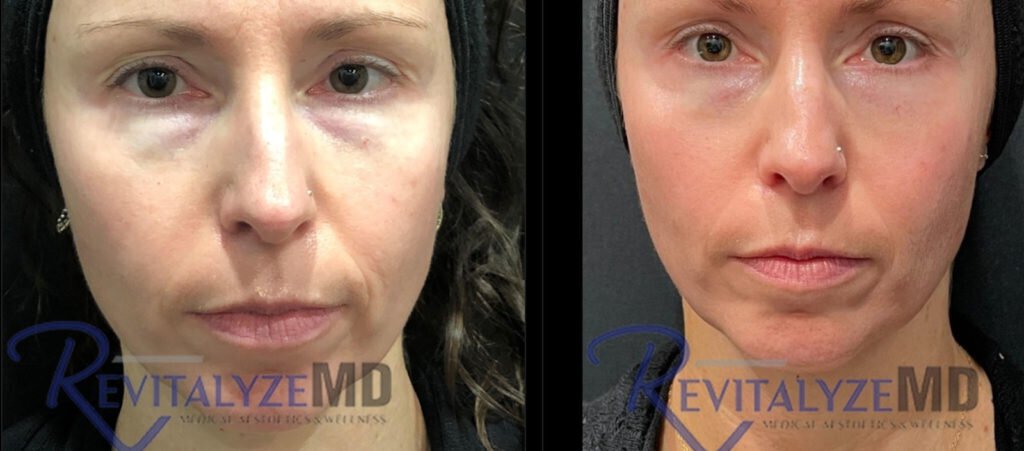revitalyzemd-prf-before-after-01-1024x451