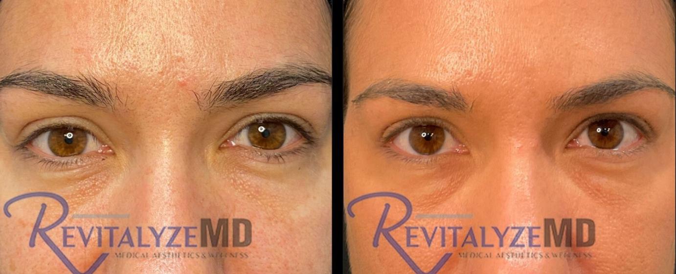 revitalyzemd-prf-before-after-06