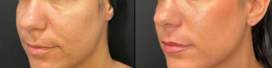 revitalyzemd-revlips-prf-before-after-01