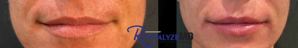 revitalyzemd-revlips-prf-before-after-02-1024x167