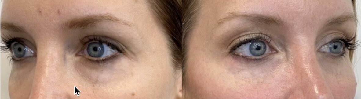 revitalyzmd-tear-through-fuller-before-after-01