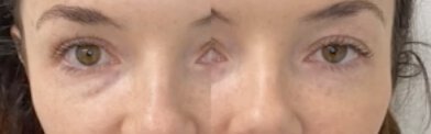 revitalyzmd-tear-through-fuller-before-after-02