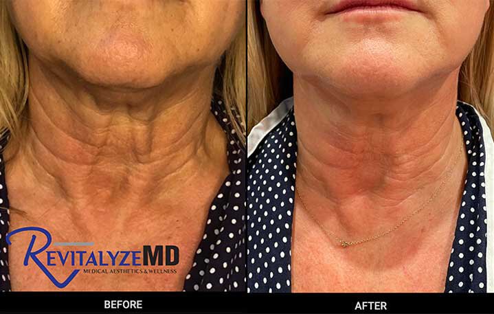 revitalyzemd-pdo-neck-before-after-01