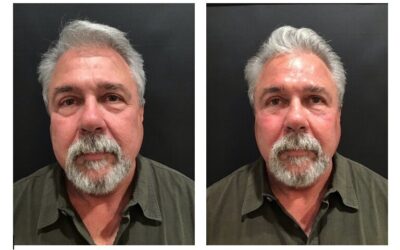Benefits Of The Vampire Facelift
