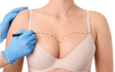 Minimizing Breast Surgery Scars With Morpheus8 In Knoxville, TN