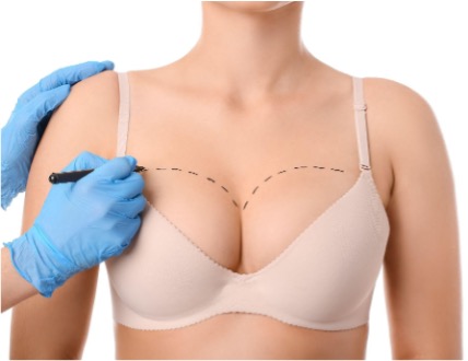 ngo-illustration-Artboard 5 Minimizing Breast Surgery Scars with Morpheus8 in Knoxville